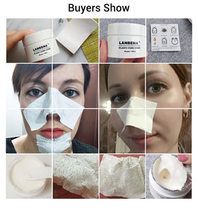 Acne Treatment Mask Skin Care - Klassiichic